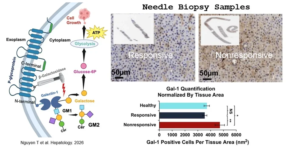 Biomarker-driven therapies for liver cancer