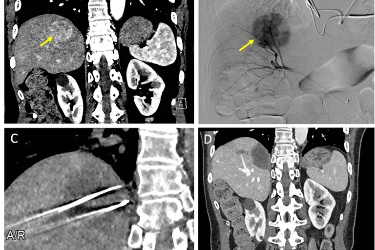 image with four sections each containing a radiology scan
