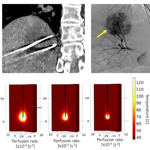 computational modeling ablation image with perfusion rates